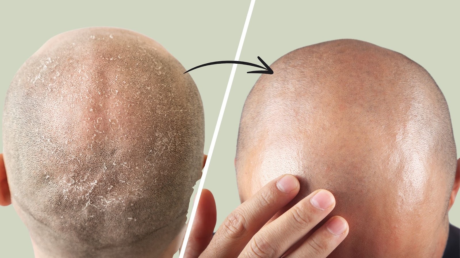 Hair Care for Bald Head: Unveil Your Shine!