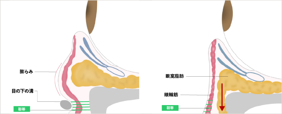 裏ハムラ法evoの仕組み