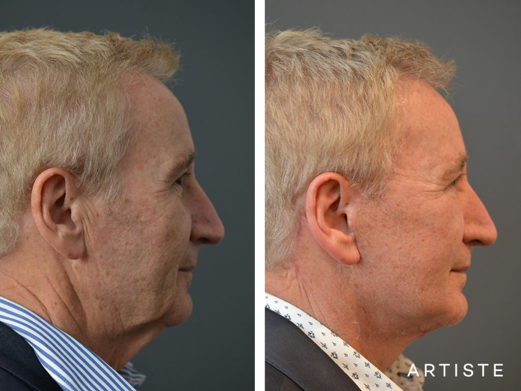 65 Years Old Face and Neck Lift