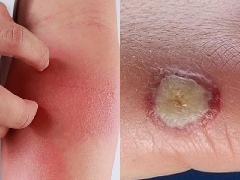 Dị ứng với vết cào hoặc vết cắn từ mèo: Khi nào cần đi khám? 2