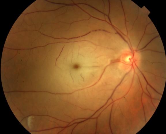 central retinal artery occlusion ile ilgili gÃ¶rsel sonucu