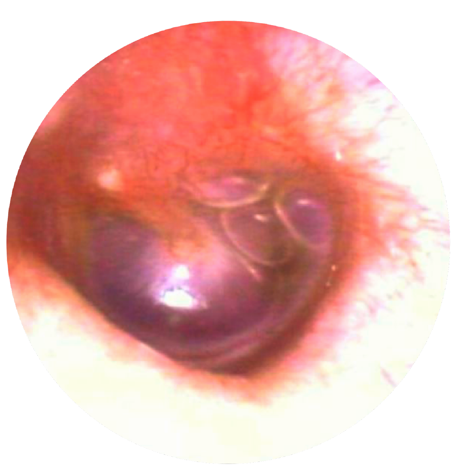 Tympanic membrane bulging with fluid in middle ear