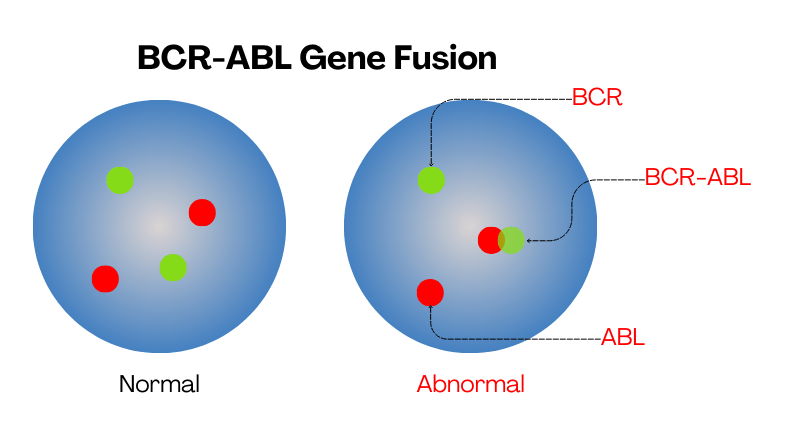 Illustration of BCR-ABL gene fusion. 