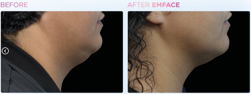 A side view of a person's face

Description automatically generated