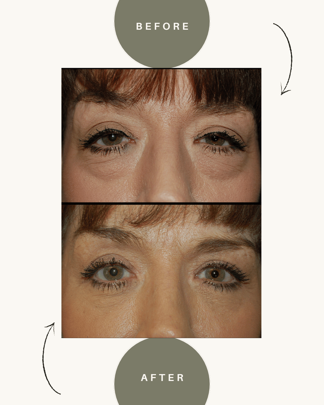  before and after eye lift surgery