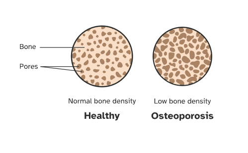 Comparison of cross-sections of healthy bone (normal bone density) and bone with osteoporosis (low bone density). Viewed under a microscope, the inside of bone resembles a honeycomb. In osteoporosis, the walls of the honeycomb (the bone) get thinner and the holes (pores) get bigger.