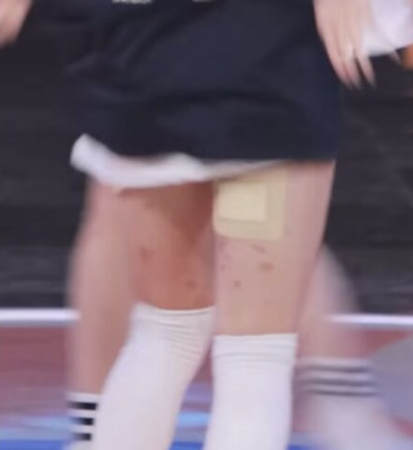 A picture of Wonhee  with noticeable marks on the back of her thighs