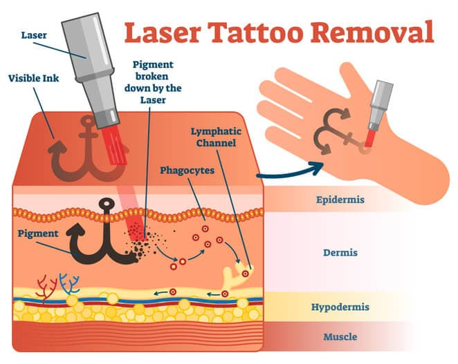 in this image the laser tattoo removal working is given.  renewyou.co.in