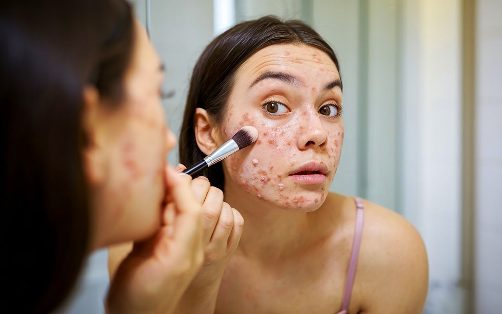 5 Common Makeup Mistakes That Make Acne Worse