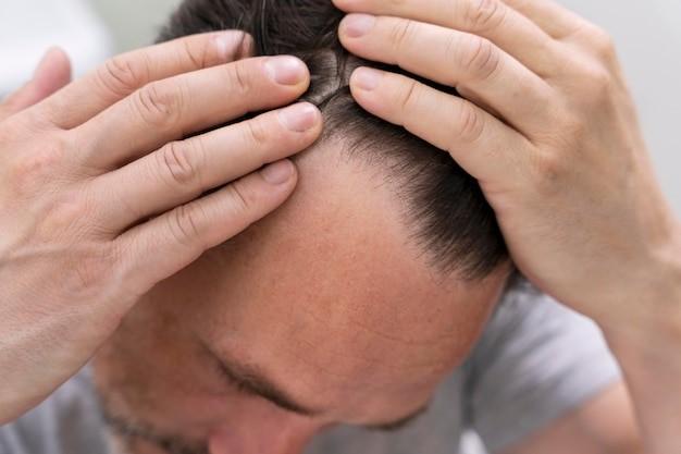 mature man having balding problems, Picture