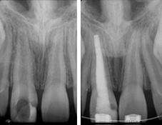 Luxaciones y expulsiones: detección y manejo de secuelas - La urgencia traumática del diente permanente - Informes de jornadas de formación - SOP Patologías de los dientes permanentes inmaduros