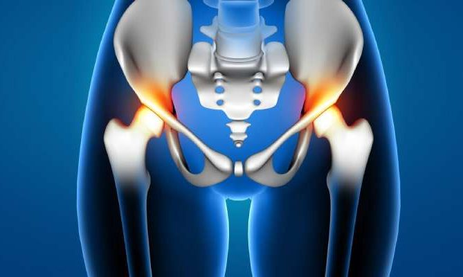 Affordable Hip Replacement Surgery in Delhi NCR