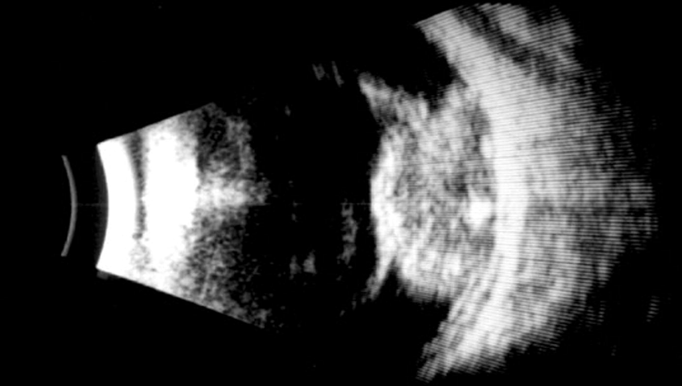 B-scan showing echogenic mass in vitreous cavity, confirming retinoblastoma.