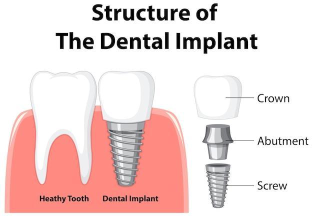 Structure of Dental Implant