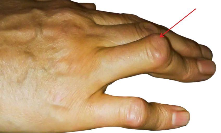 Typical Deformities Hand