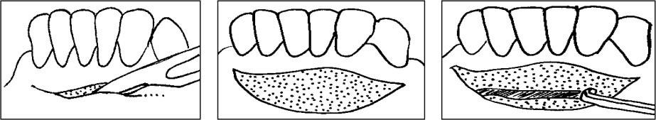C:\Users\DELL\Pictures\vestibuloplasty.png