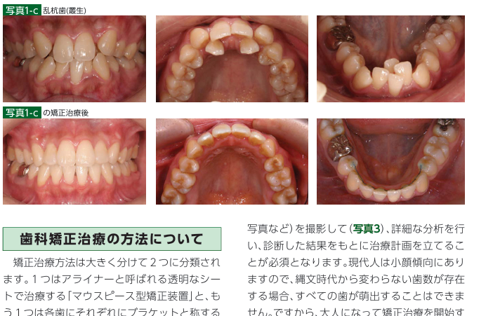 マウスピースで八重歯は矯正できる？