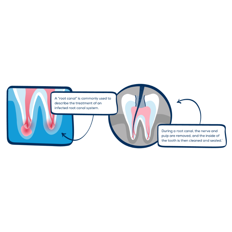 Root Canal FAQs Answered by SmileStudio Experts