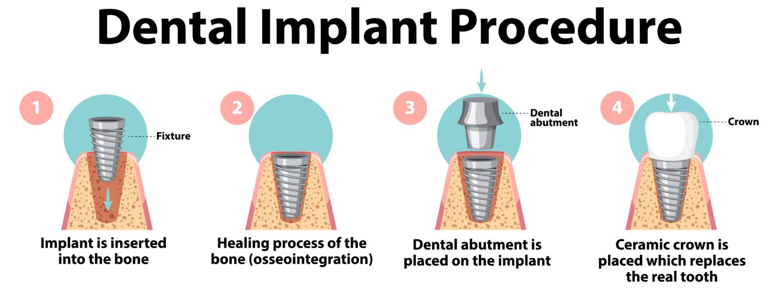 step-by-step-dental-implant-procedure