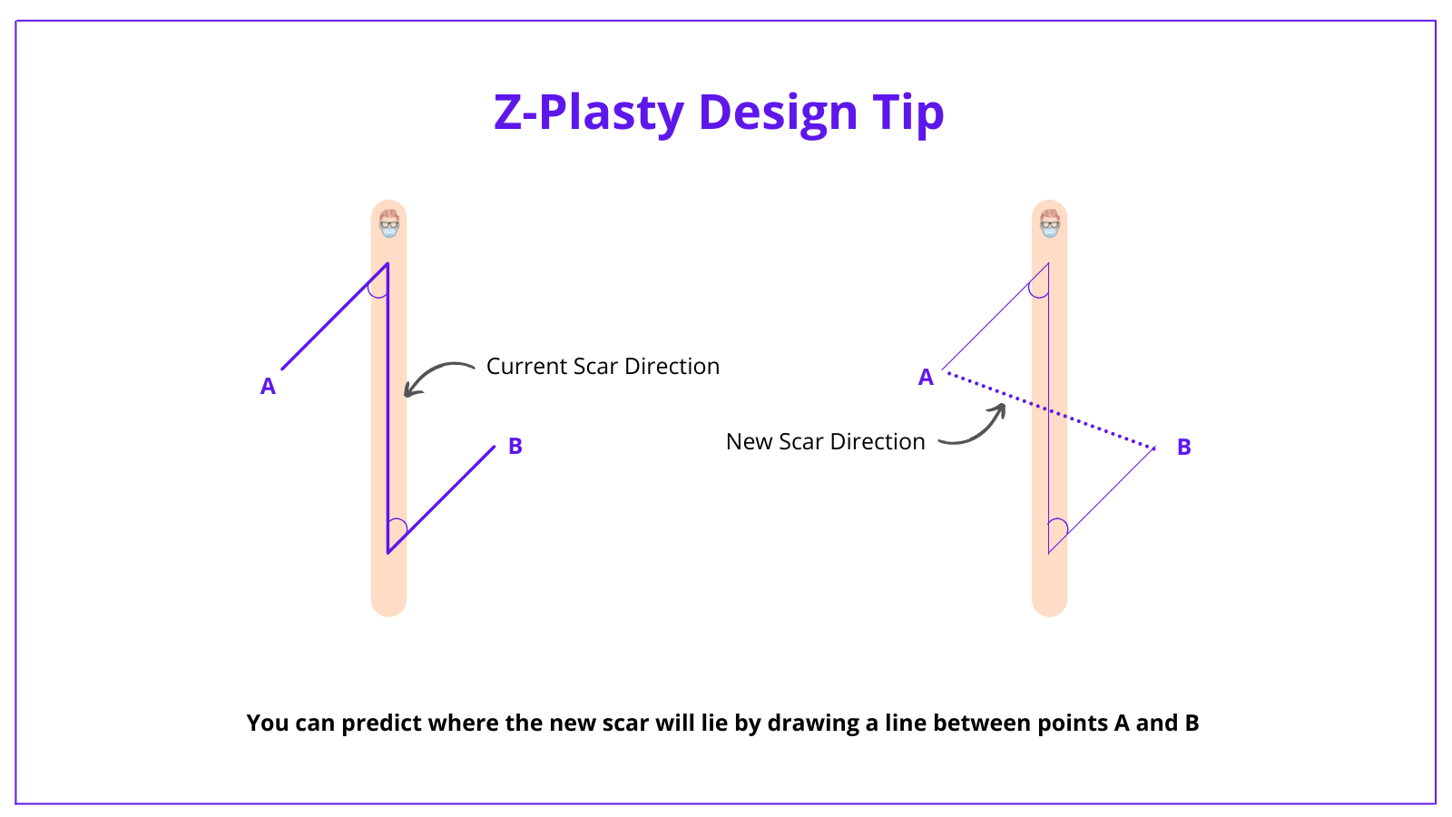 Z-Plasty Flap Design