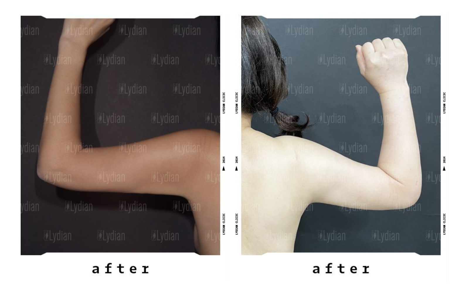 arm liposuction before and after