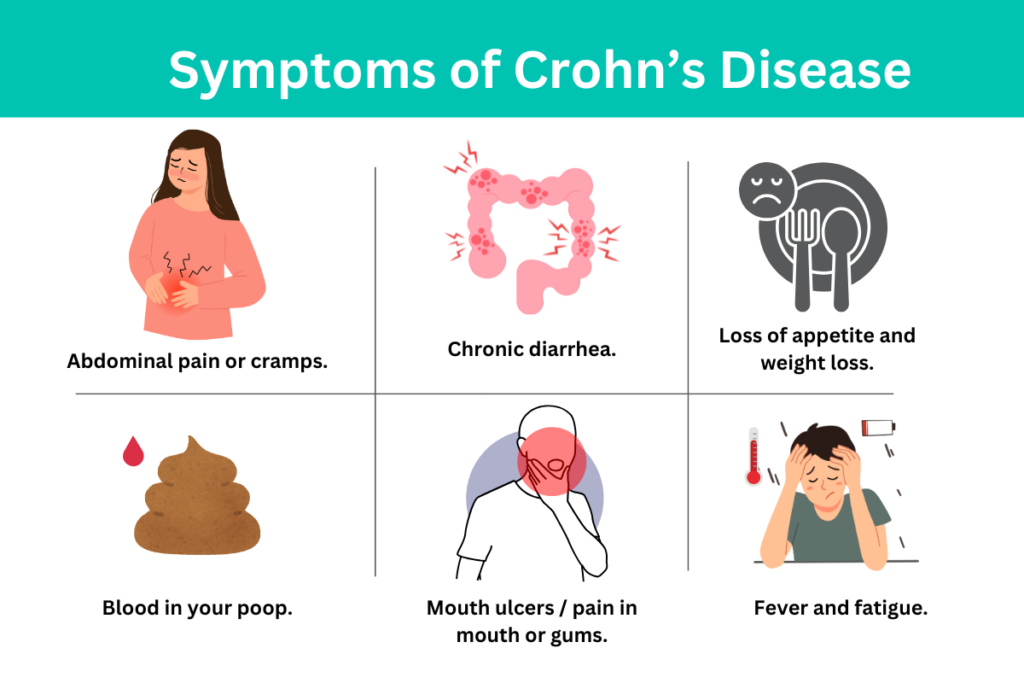 Symptoms of Crohn’s Disease