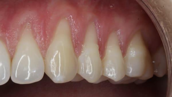 C:\Usuarios\DELL\Imágenes\injerto de encía, recubrimiento, recesión periodontal, impacto estético, tratamiento, aflojamiento dental, consulta de periodoncia, París, 11, periodoncista, París.jpeg