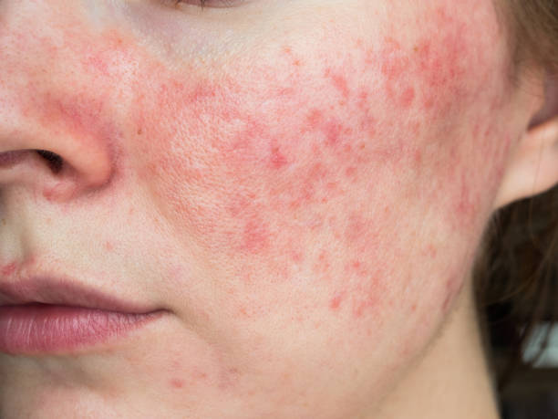 Close-up of a woman's cheek with red, inflamed acne and sensitive skin, showing symptoms of rosacea or skin irritation.