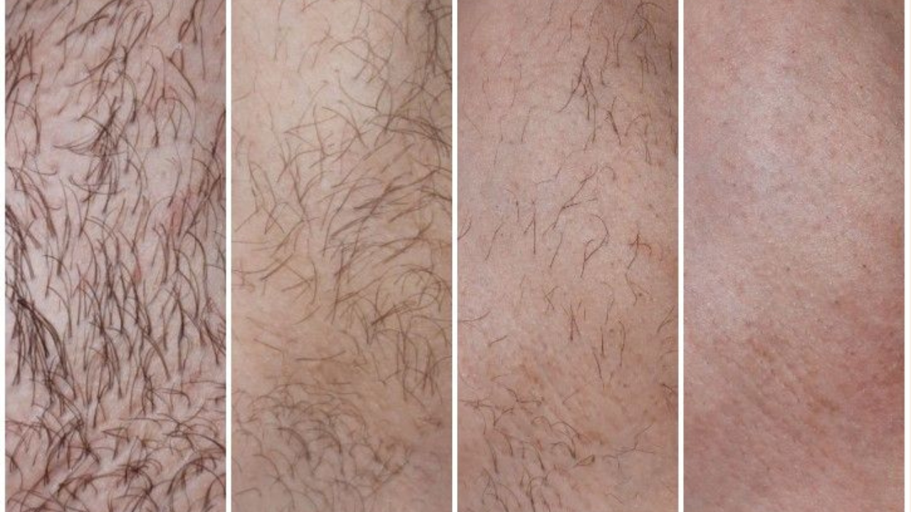 This contain the progress of a successful permanent electrolysis hair removal 