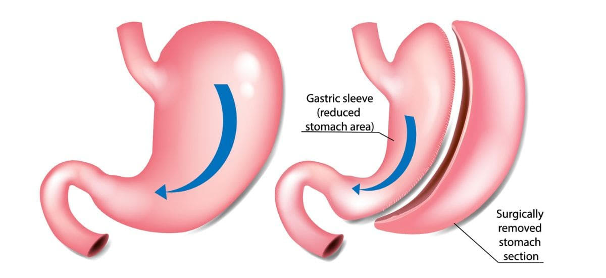 Sleeve gastrectomy