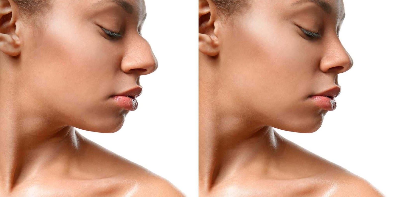 picture describe nose job shape makeover