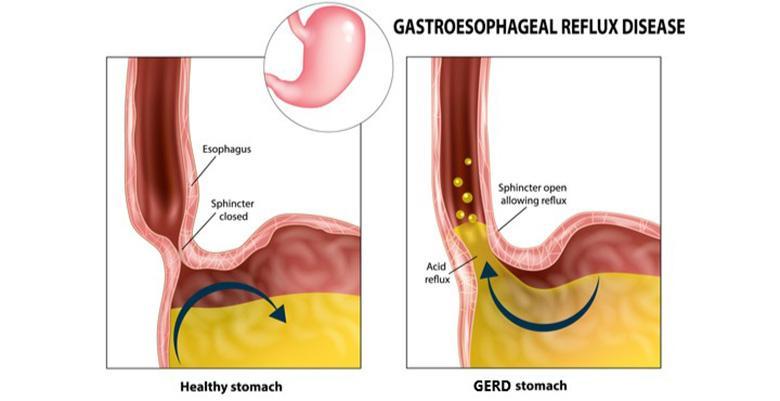 Gastroesophageal Reflux Disease (GERD) - Causes and Symptoms | Parkway East Hospital