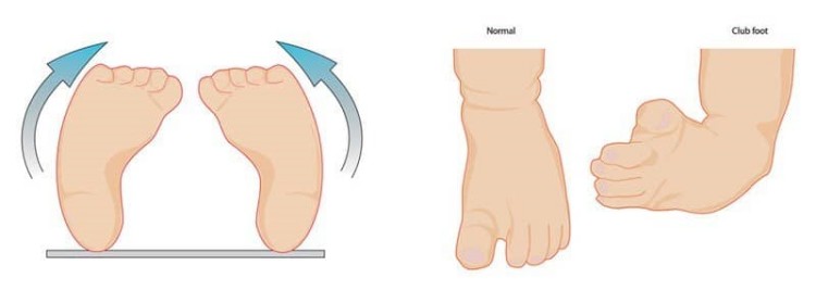 علاج اعوجاج القدم للداخل عند الاطفال