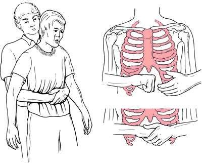 C:\Users\se7en\Desktop\Heimlich_manoeuvre.png
