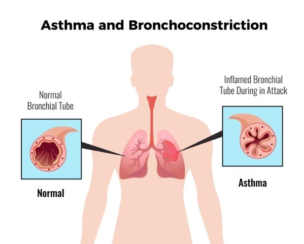 Diagram illustrating asthma and broncoconstriction, showing a normal bronchiolar tube and an inflamed bronchiolar tube during an asthma attack