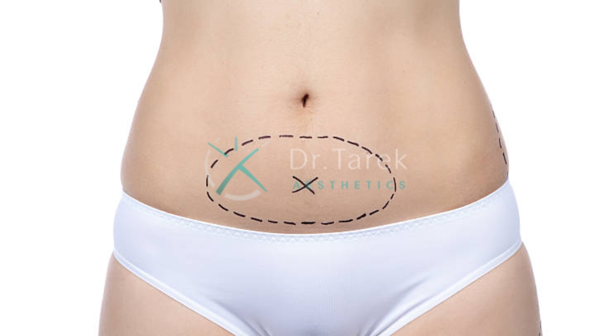 Where Is Lipo To Flanks 5 Dr. Tarek Aesthetics | Best Plastic Surgeon In Dubai Where Is Lipo To Flanks