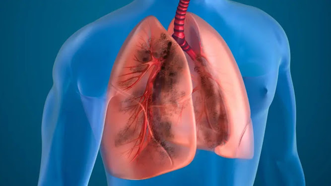 Multifocal Pneumonia