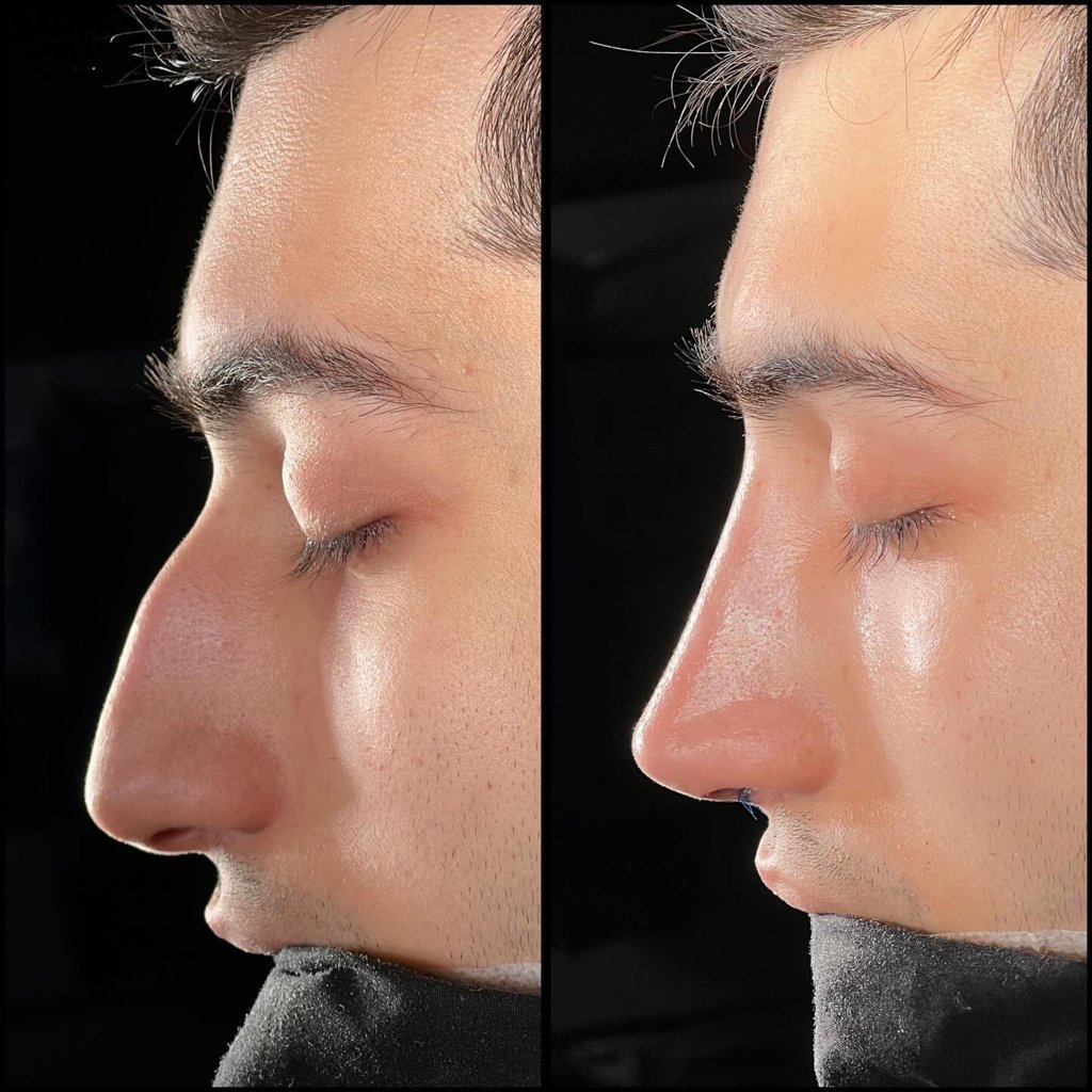 a picture describe dorsal hump nose job correction