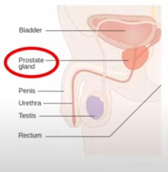 prostate cancer