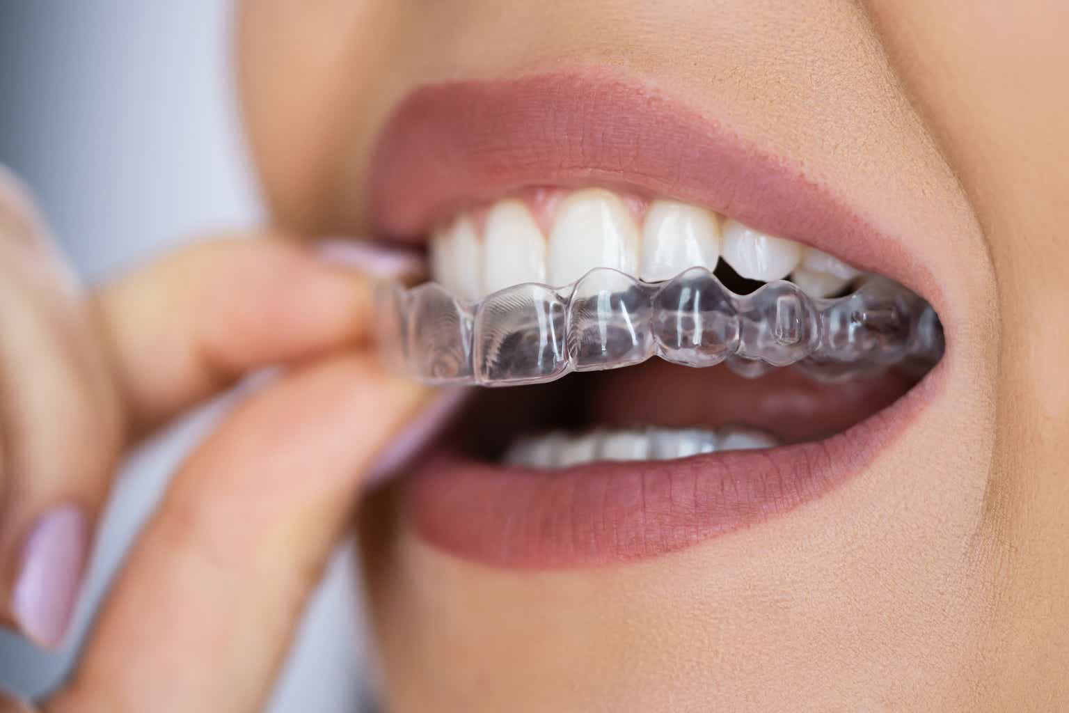 Align Technology Share Price 100$ 400$ Invisalign Cost Costco