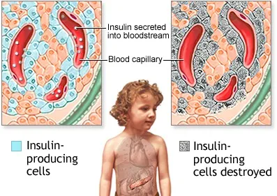 Type 1 diabetes 