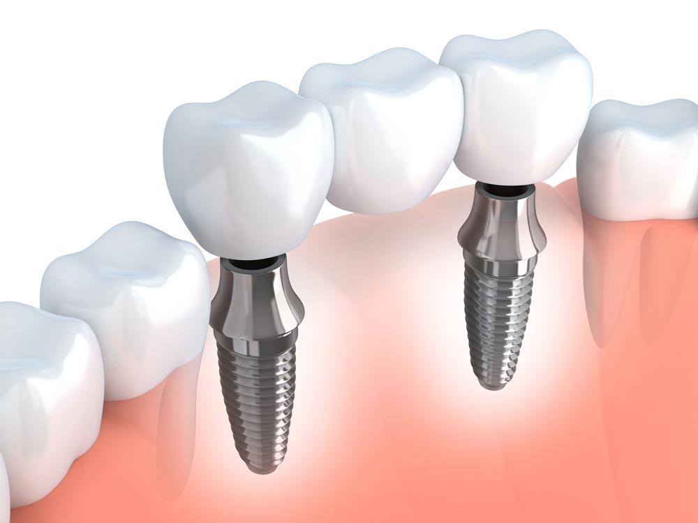 C:\Users\Acer\Pictures\fixed-bridge-implants.jpg