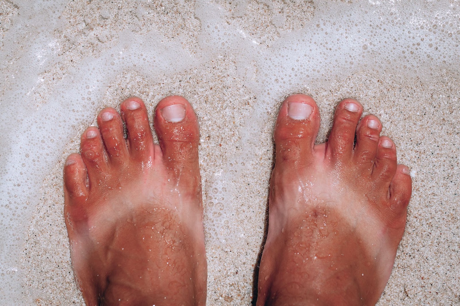 sunburn feet sand