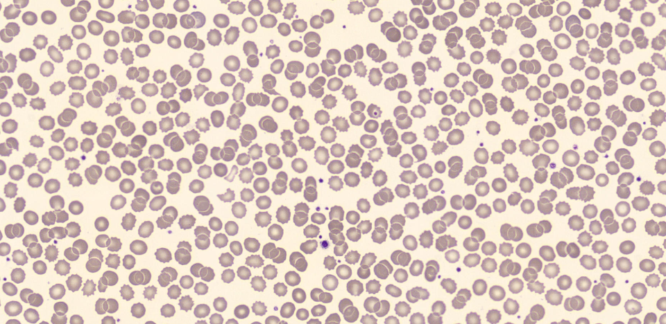 doença renal crônica