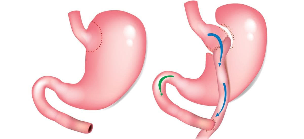 Roux-en-Y gastric bypass surgery