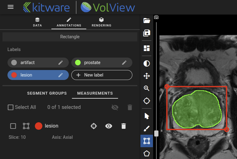 VolView web app with prostate annotations