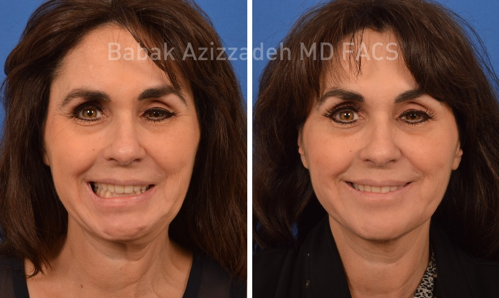 facial synkinesis