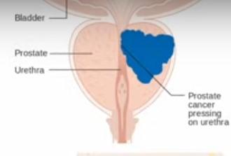 C:\Users\Administrator\Desktop\articles pics\health4992\05-01-2025\Prostate Cancer\prostate cancer-1.jpg