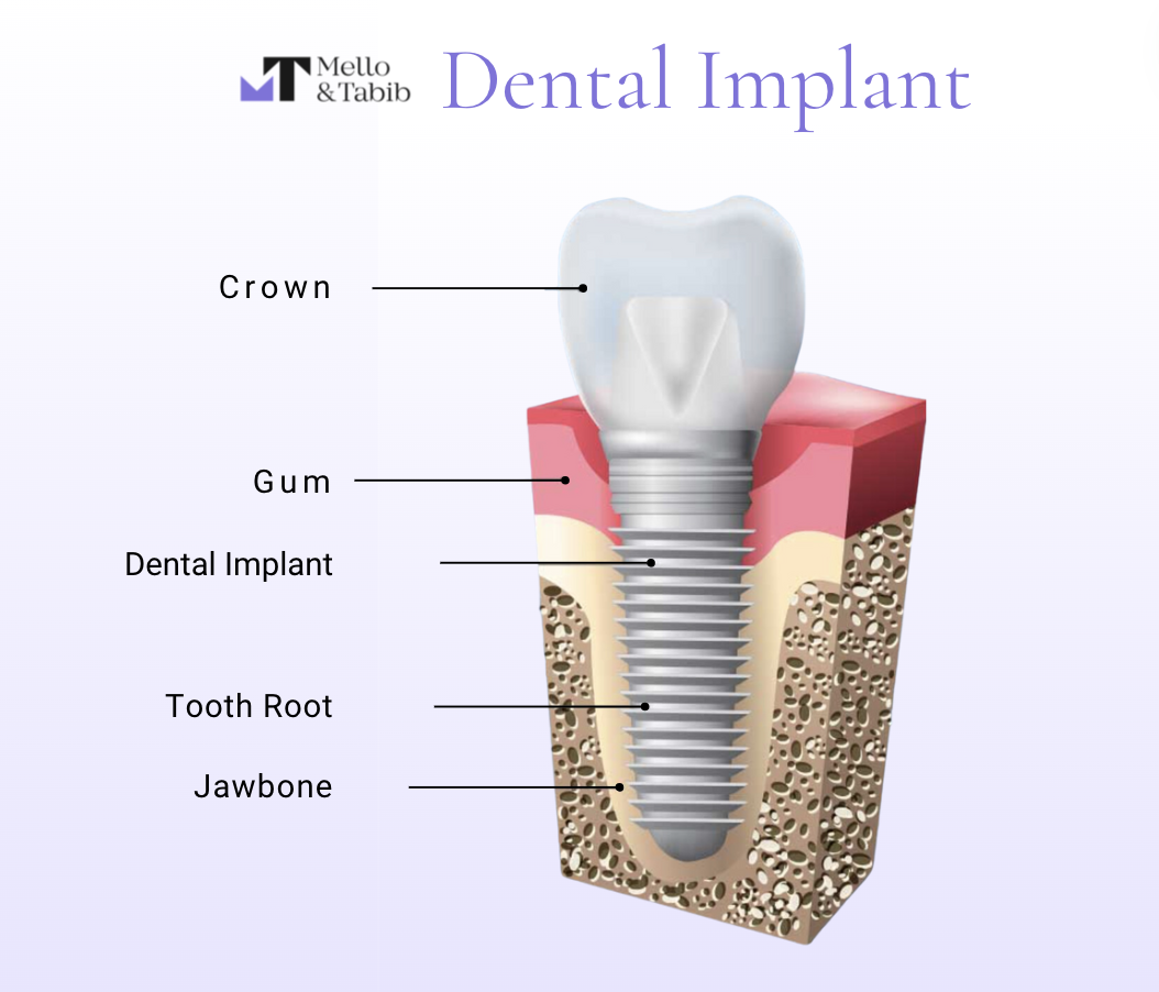 Dental implant diagram