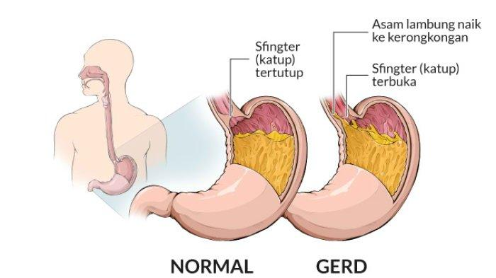 Epidemiologi Penyakit GERD : Berpengaruhkah Terhadap Puasa Ramadhan?